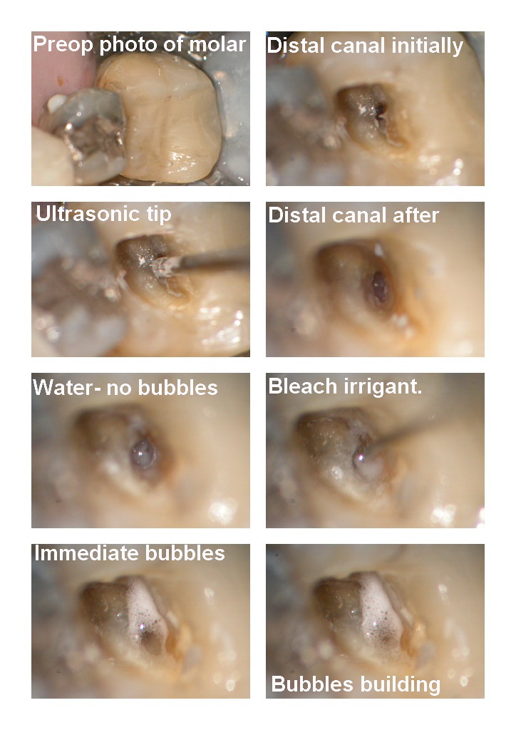 Endo on molar edited.jpg